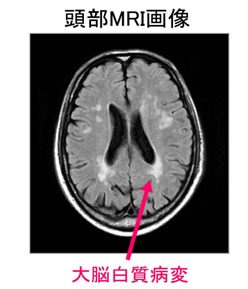 GFAP遺伝子の変異が認知症の発症に関わる大脳白質病変に影響～脳画像所見における遺伝的要素の新知見～