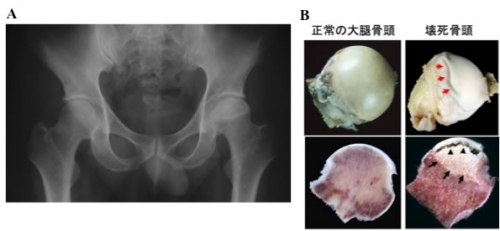 大腿骨頭壊死症の遺伝子を発見 －病因の解明・治療のブレークスルーに－ | 研究成果 | 九州大学（KYUSHU UNIVERSITY）
