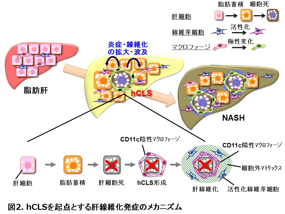 肥満症 | 肥満症とNAFLD/NASH | 肥満症に関するトピックス
