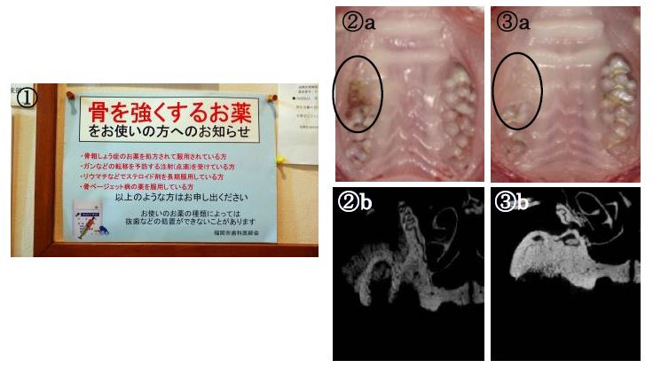 薬剤関連顎骨壊死の予防薬候補の発見 ~安心・安全な歯科治療へ 薬剤関連顎骨壊死の予防薬候補の発見 ~安心・安全な歯科治療へ
