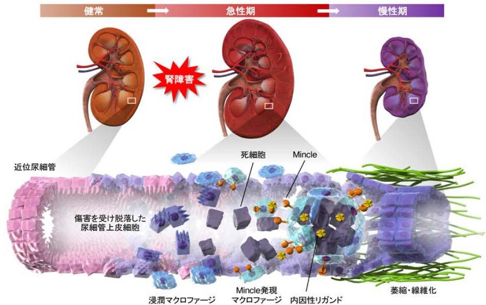 死細胞センサーMincleによる急性腎障害の慢性化メカニズムを解明